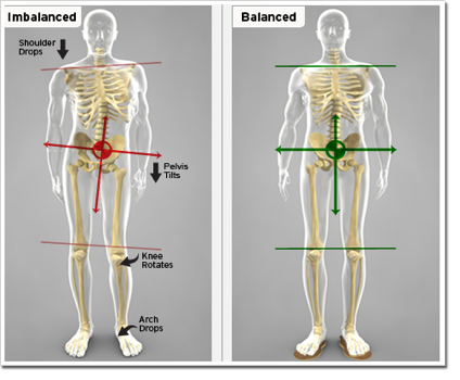 Short Leg Syndrome (Leg Length Discrepancy)